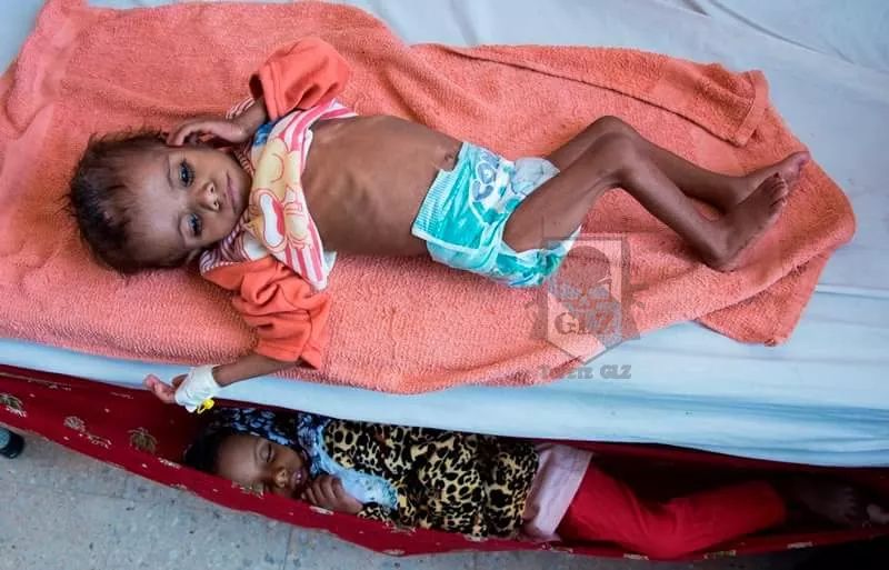 Calcula ONG 85 mil niños muertos en Yemen por hambre