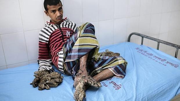 'Hombre árbol' de Bangladesh tendrá que volver al quirófano