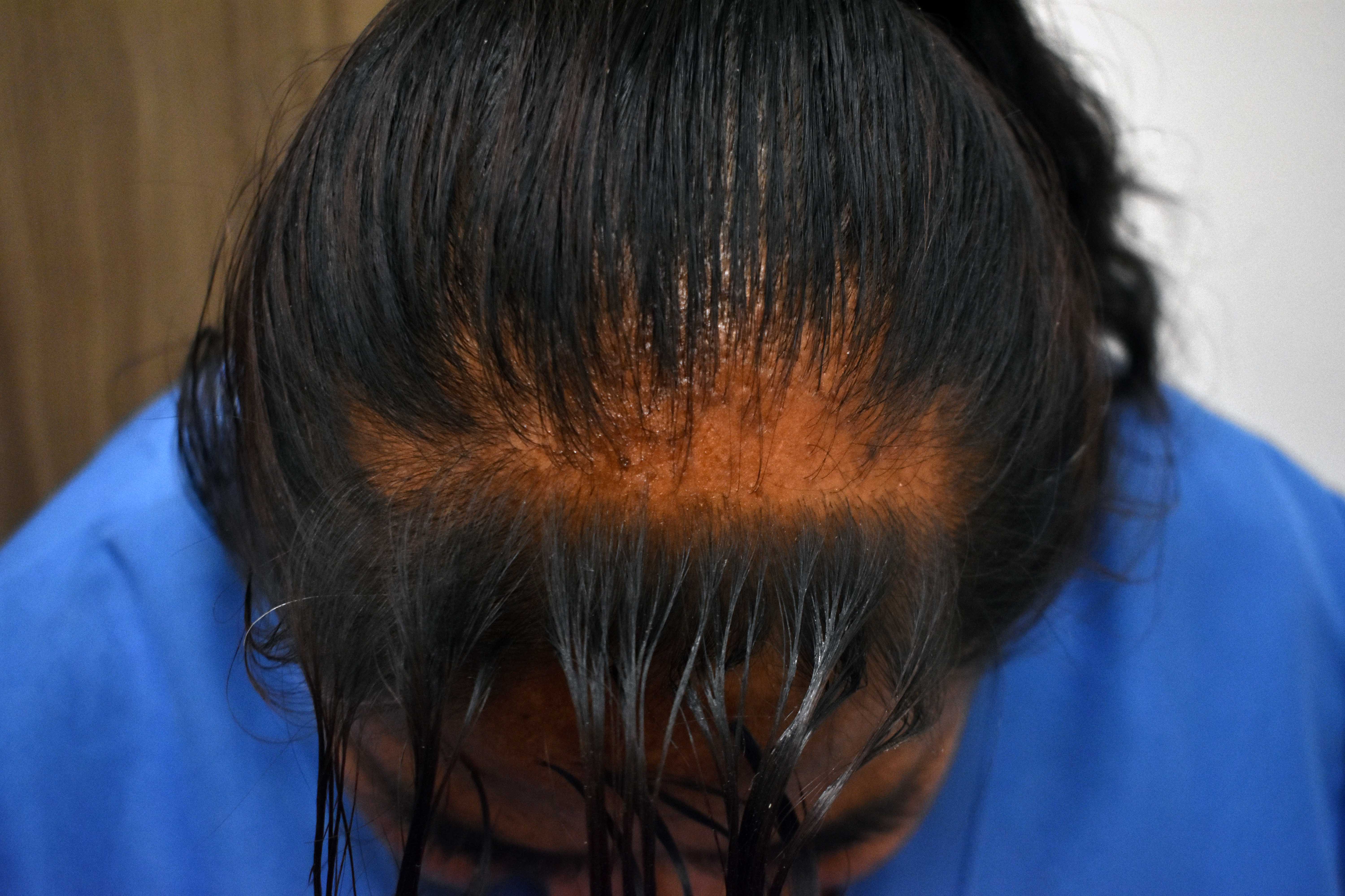 Detectan causas que provocan pérdida de cabello