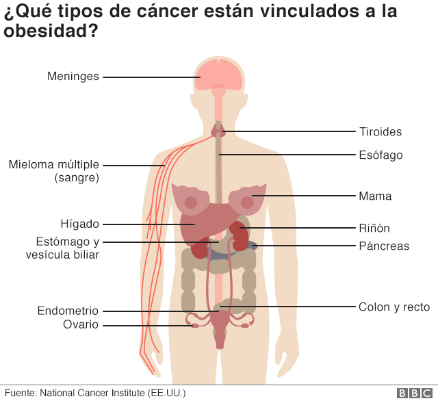 Obesidad, principal causa de 4 tipos de cáncer