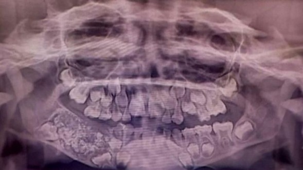 526 dientes retirados a niño de 7 años
