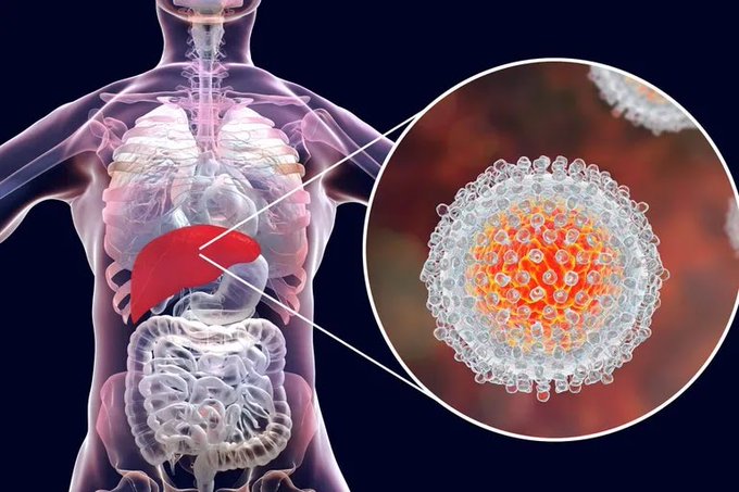 Detectan primer caso de hepatitis infantil aguda en país de Latinoamérica