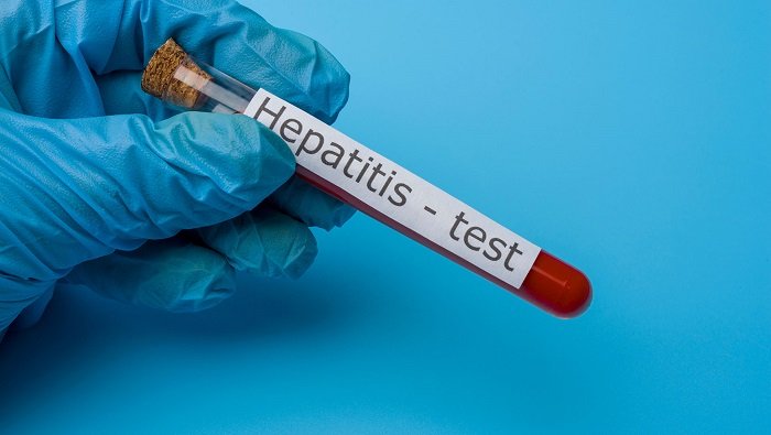 Investigan en Durango posible caso de hepatitis aguda infantil