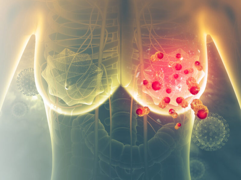 tratamiento de UNAM contra cáncer de mama