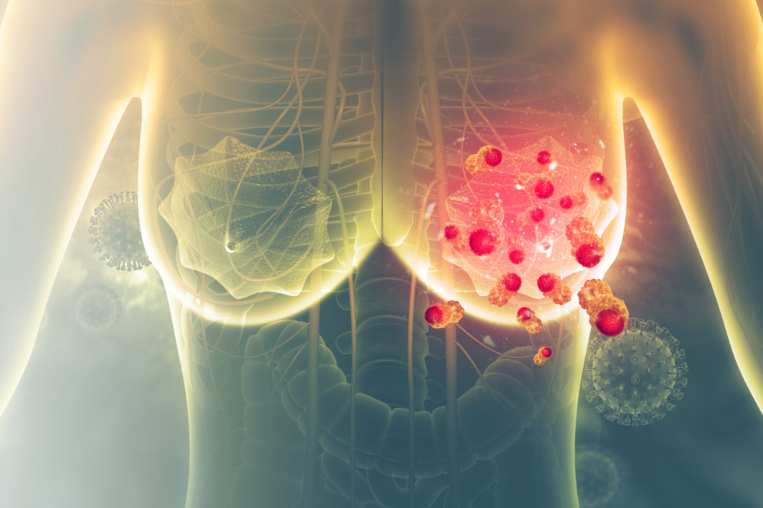 tratamiento de UNAM contra cáncer de mama