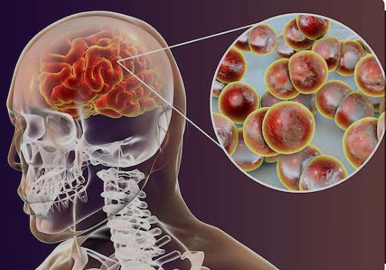 Daños neurológicos por la meningitis bacteriana