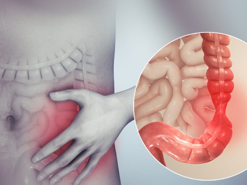 Estrés, ansiedad y depresión causan síndrome de intestino irritable