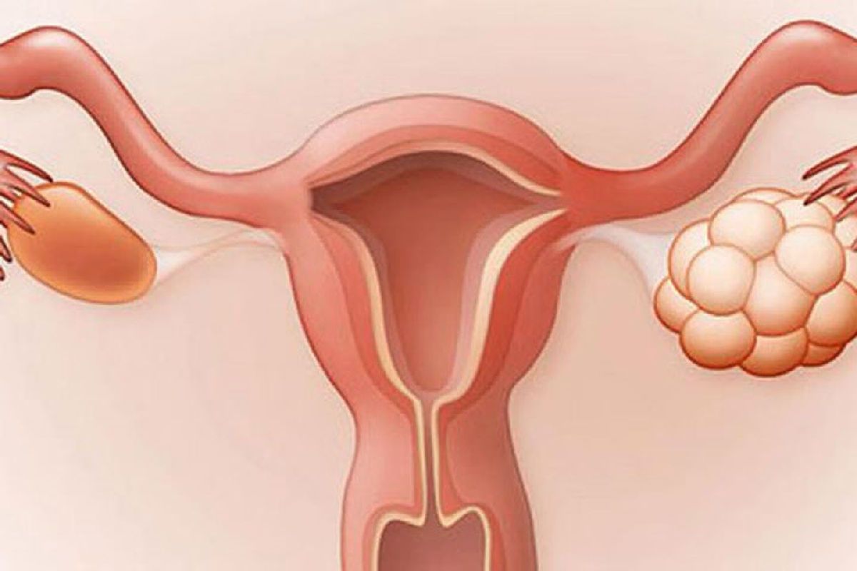 explican impacto del síndrome del ovario poliquístico