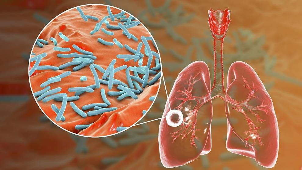 Prevención y cura de la tuberculosis pulmonar - pulmones