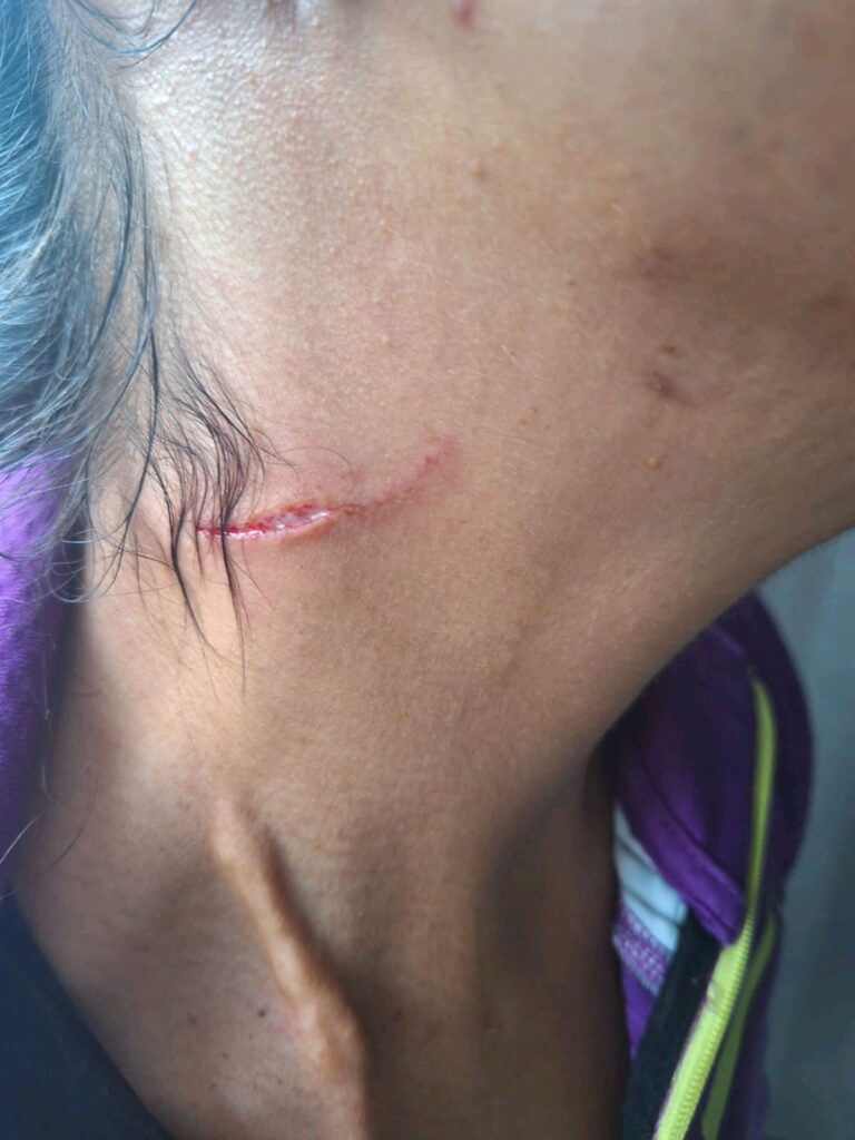 asaltos en Morelia en una moto blanca - heridas