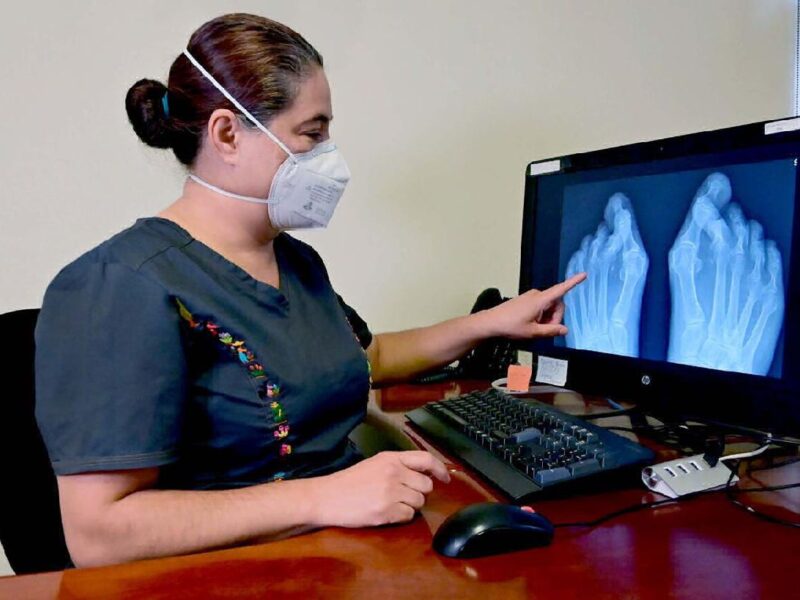 los síntomas de la artritis reumatoide