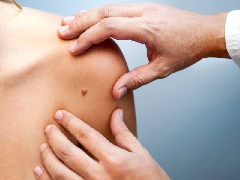 La detección temprana del Sarcoma