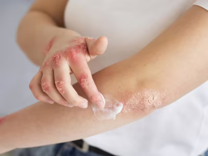 Impacto de la dermatitis atópica en niños y adultos tratamientos innovadores