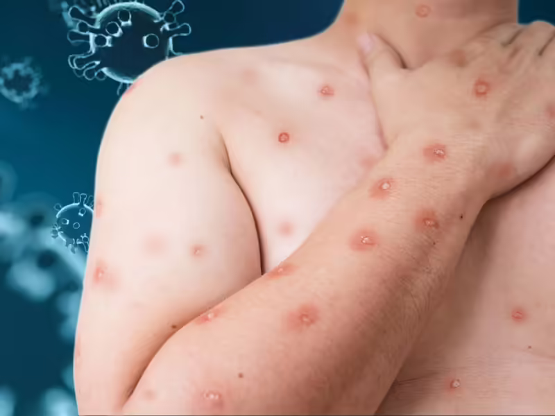 Sector Salud inicia capacitación mpox en México