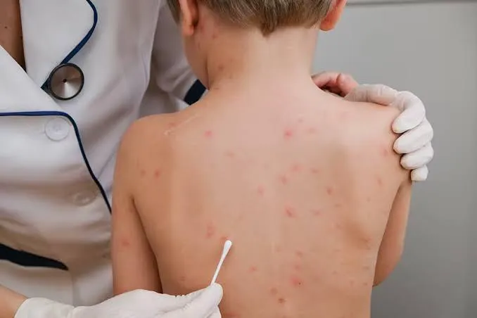 Muere segundo niño por causas relacionadas con sarampión en Texas