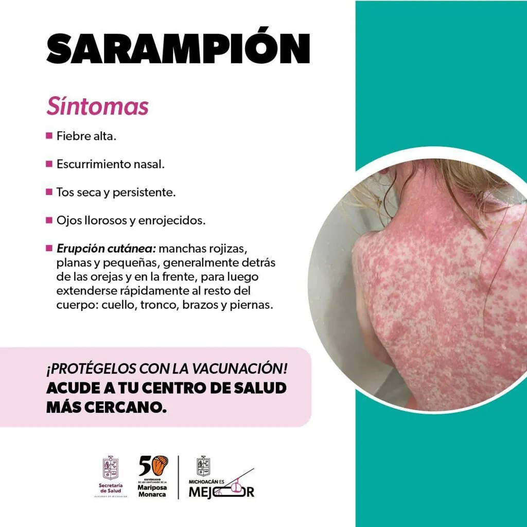 Identifica los síntomas del sarampión y protege tu salud: SSM-1