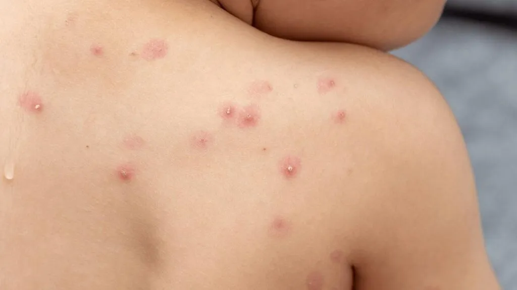 Imagen de paciente con caso de Mpox