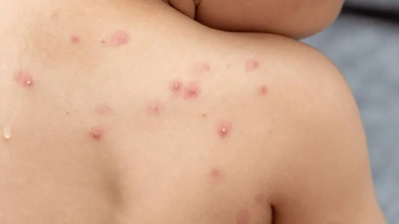 Imagen de paciente con caso de Mpox