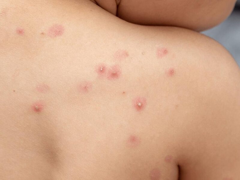 Imagen de paciente con caso de Mpox