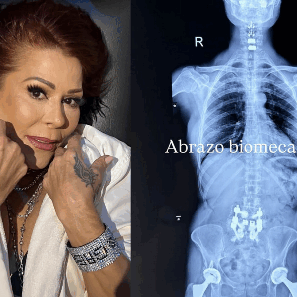 Alejandra Guzmán revela su “abrazo biomecánico” tras cirugía