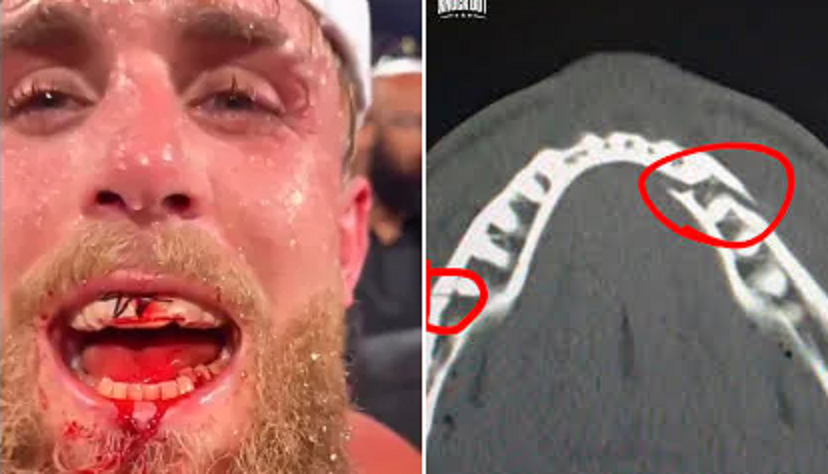 92 millones por una fractura doble de mandíbula de Jake Paul por enfrentar a Joshua en Netflix-1