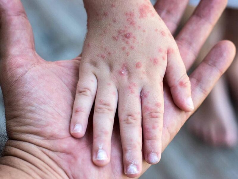 Sarampión supera los 11 mil contagios confirmados en México
