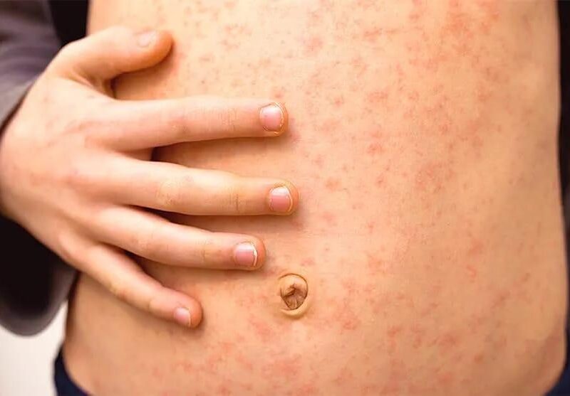 Suman 165 casos de sarampión en Michoacán; 25 en Morelia